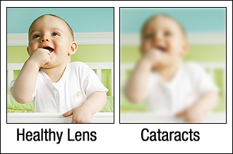 Cataract.png